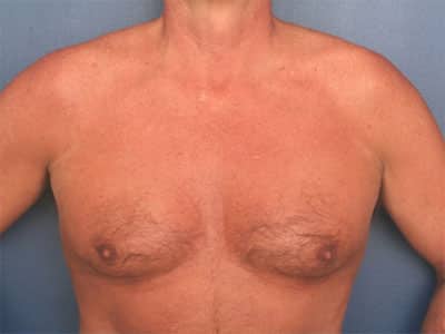 Before Image: Gynecomastia - front