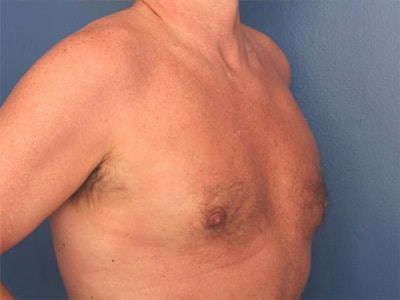 After Image: Gynecomastia - right-front-oblique