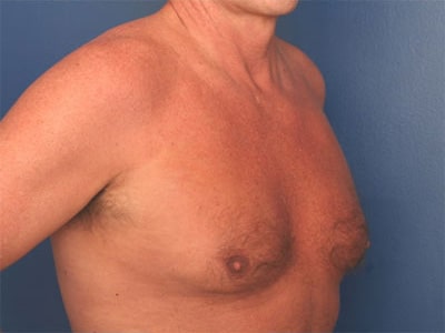 Before Image: Gynecomastia - right-front-oblique