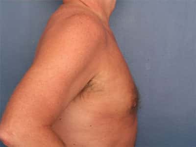 After Image: Gynecomastia - right-side