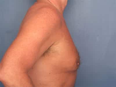 Before Image: Gynecomastia - right-side