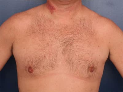 After Image: Gynecomastia - front