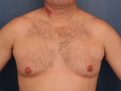 Before Image: Gynecomastia - front