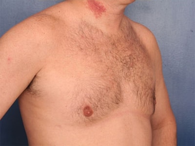 After Image: Gynecomastia - right-front-oblique