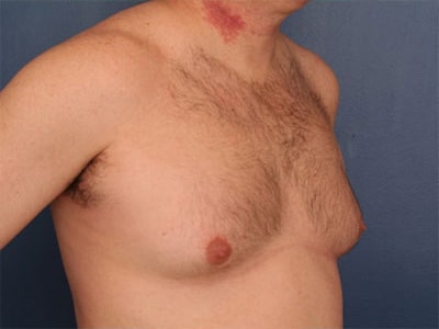Before Image: Gynecomastia - right-front-oblique