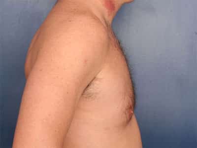 After Image: Gynecomastia - right-side