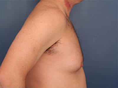 Before Image: Gynecomastia - right-side
