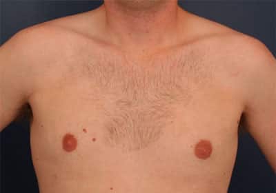 After Image: Gynecomastia - front