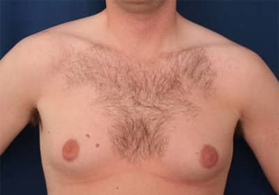 Before Image: Gynecomastia - front