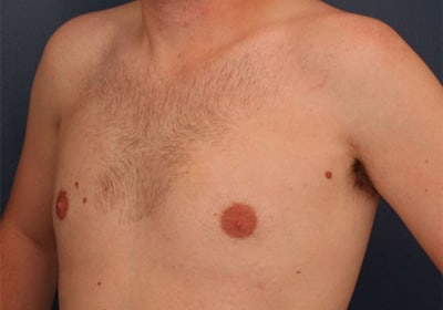 After Image: Gynecomastia - left-front-oblique