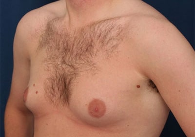 Before Image: Gynecomastia - left-front-oblique