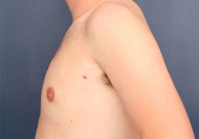 After Image: Gynecomastia - left-side