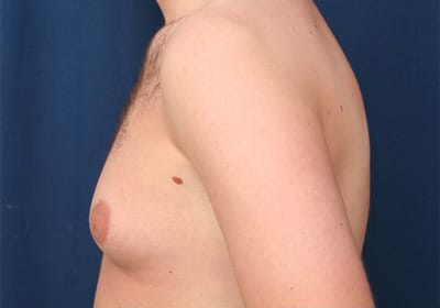 Before Image: Gynecomastia - left-side
