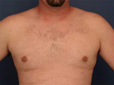 After Image: Gynecomastia - front