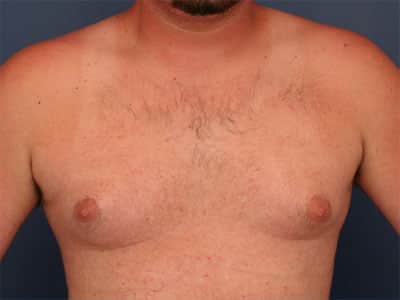Before Image: Gynecomastia - front