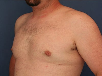After Image: Gynecomastia - left-front-oblique