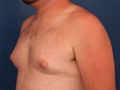 Before Image: Gynecomastia - left-front-oblique