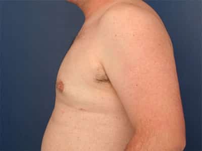 After Image: Gynecomastia - left-side