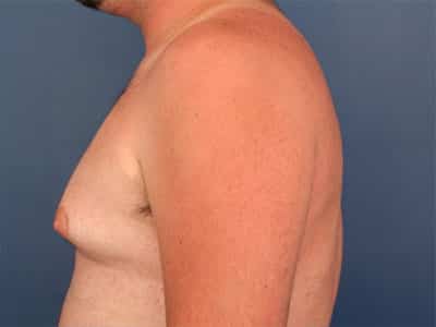 Before Image: Gynecomastia - left-side