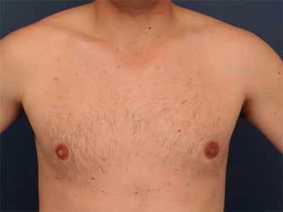 After Image: Gynecomastia - front