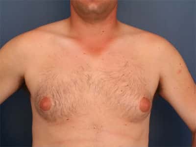 Before Image: Gynecomastia - front