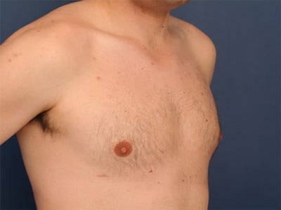 After Image: Gynecomastia - right-front-oblique