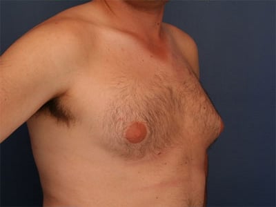 Before Image: Gynecomastia - right-front-oblique