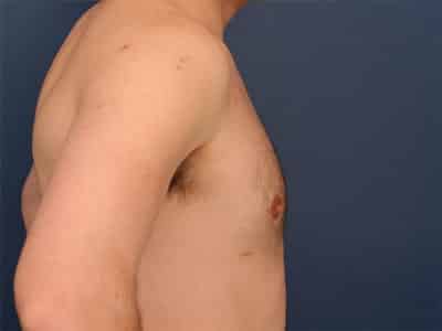 After Image: Gynecomastia - right-side