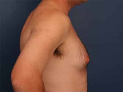 Before Image: Gynecomastia - right-side