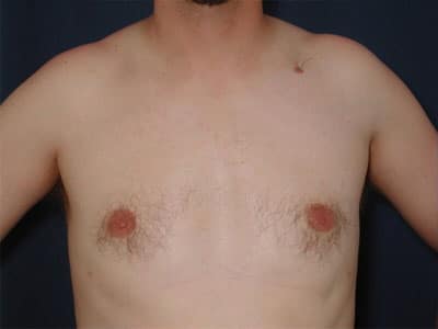 After Image: Gynecomastia - front