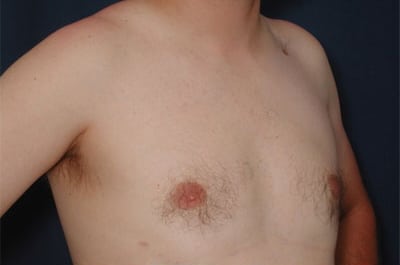 After Image: Gynecomastia - right-front-oblique