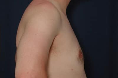 After Image: Gynecomastia - right-side