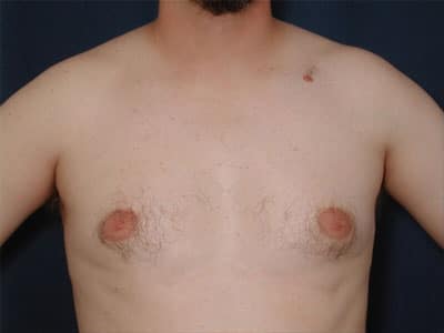 Before Image: Gynecomastia - front
