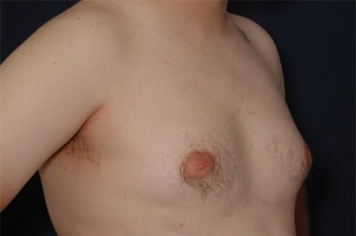 Before Image: Gynecomastia - right-front-oblique