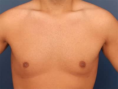 After Image: Gynecomastia - front