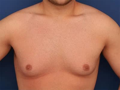 Before Image: Gynecomastia - front
