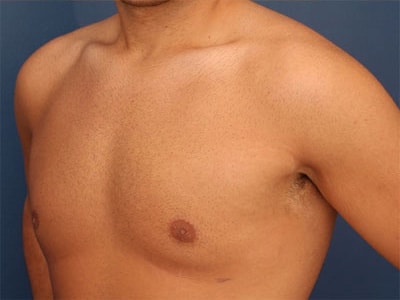 After Image: Gynecomastia - left-front-oblique