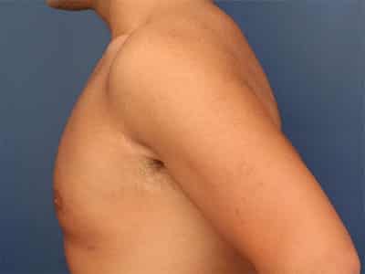 After Image: Gynecomastia - left-side