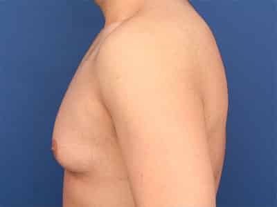 Before Image: Gynecomastia - left-side