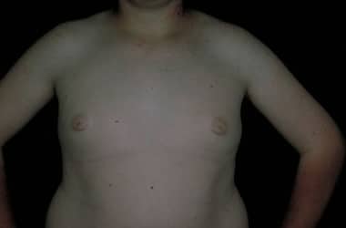 After Image: Gynecomastia - front