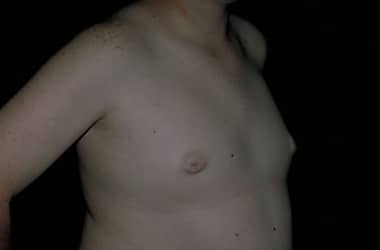 After Image: Gynecomastia - right-front-oblique
