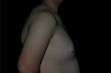 After Image: Gynecomastia - right-side