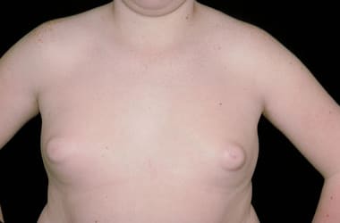 Before Image: Gynecomastia - front