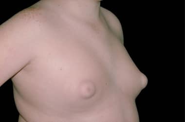 Before Image: Gynecomastia - right-front-oblique