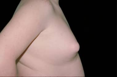 Before Image: Gynecomastia - right-side