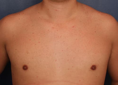 After Image: Gynecomastia - front