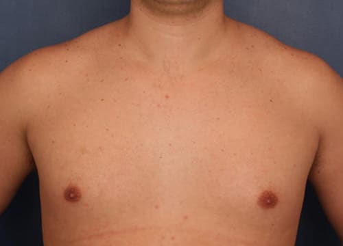 Before Image: Gynecomastia - front