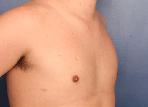 After Image: Gynecomastia - right-front-oblique