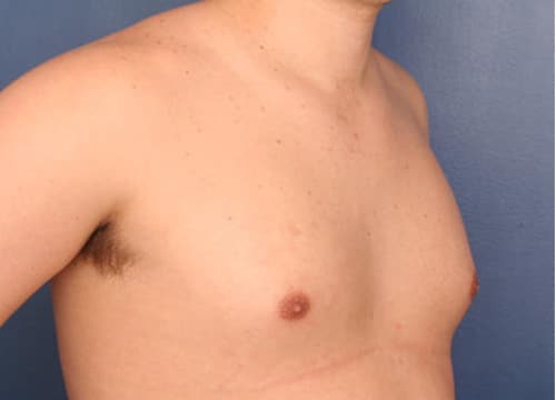 Before Image: Gynecomastia - right-front-oblique