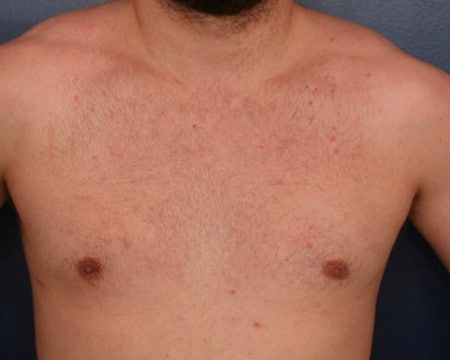 After Image: Gynecomastia - front